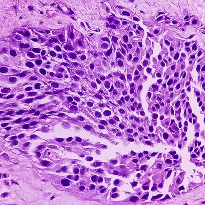 bladder cancer web