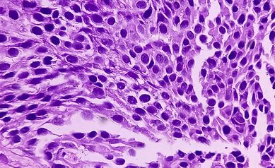 A Mentor, Innovator, and Leader in Bladder Cancer