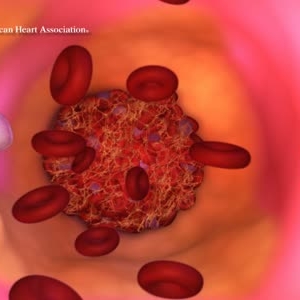 Effectiveness of anti-clotting meds after stent placement varied in people with diabetes