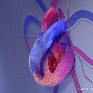 Cardiomyopathy animation