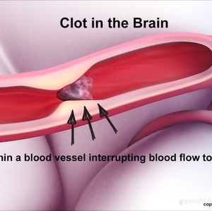 Clot in brain infographic
