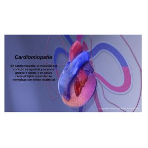 Cardiomyopathy - Spanish