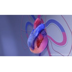 El esfuerzo ampliado ayudará a estandarizar y mejorar la atención de la miocardiopatía hipertrófica 