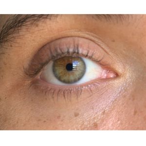 Stroke affecting the eye requires immediate treatment, can signal future vascular events