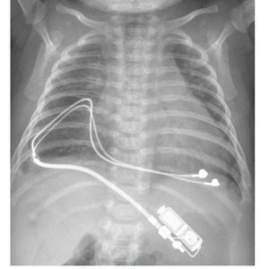 Tiny pacemakers safely stabilize newborns’ hearts for up to two years 